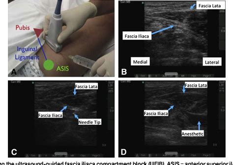 Figure 1 from Ultrasound-guided fascia iliaca compartment block for hip ...