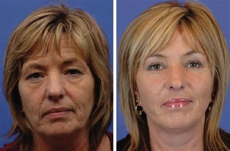 Face improvements without surgery. Sagging jowls and turkey neck can be ...