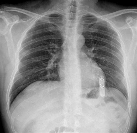 Implanted Cardiac Event Recorder (Loop Recorder) - MR IMPLANT