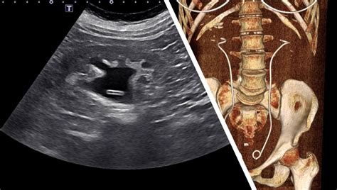 Sonographic appearance of an ureteral stent – NephroPOCUS