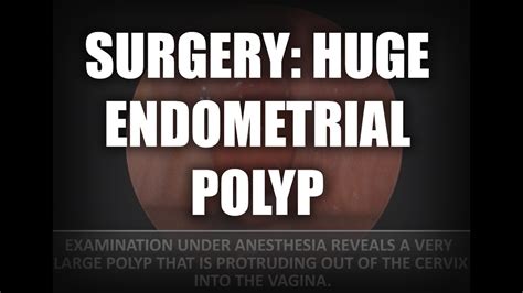 Surgery: Huge endometrial (uterine) polyp removal - YouTube