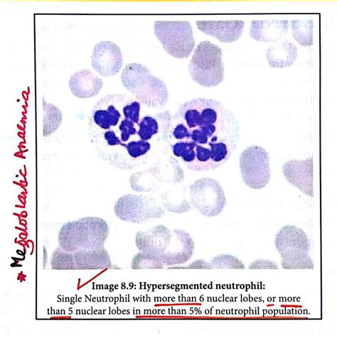 Hypersegmented Neutrophils - Megaloblastic anaemia ... ( Note: Hyposegmented Neutrophil ...