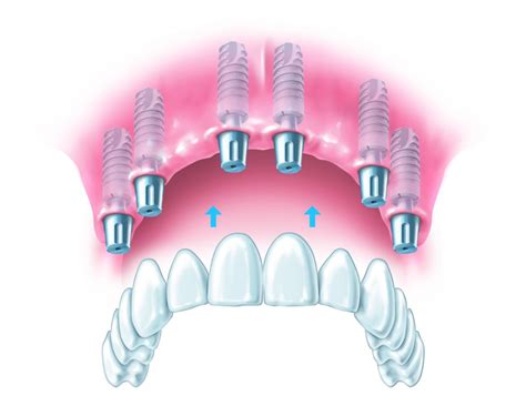 fixed bridge | Ten Implant Centre