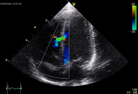 Echocardiography - Wikipedia