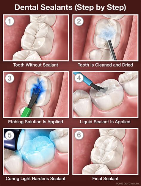 Dental Sealants | Pediatric & Adolescent Dentistry of the Main Line | Bryn Mawr PA