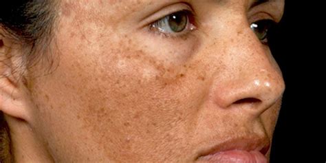 Melasma – Arlington Skin Doctor