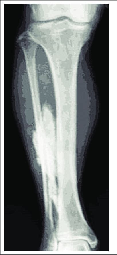 Myonecrosis in the leg. | Download Scientific Diagram