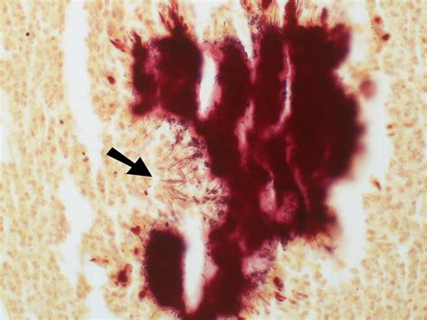 Actinomycosis - Gram stain | Thin Gram positive filamentous … | Flickr