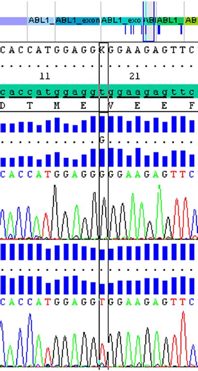 BCR-ABL tyrosine kinase domain mutation analysis in peripheral blood ...