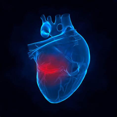 Acute MI (Heart Attack)Interventions | Cardiovascular Consultants Ltd.