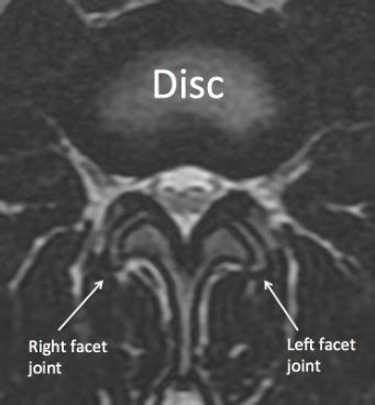 Ligamentum Flavum And Facet Hypertrophy