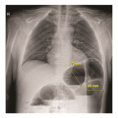 Plain X-ray in standing position showing aerocoly in the epigastric... | Download Scientific Diagram