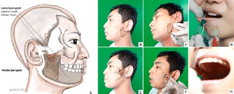 Medial Pterygoid Muscle