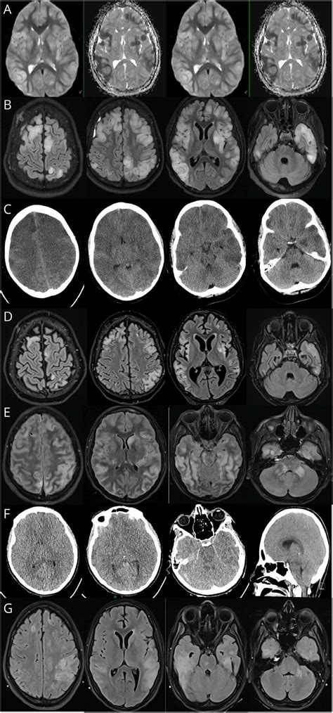 Neuroimaging Features of Malignant MOGAD | Download Scientific Diagram