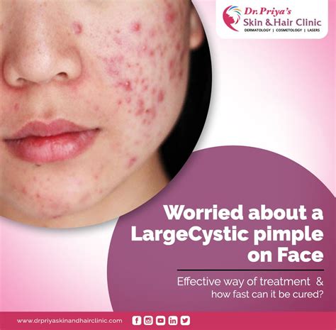 Cystic pimples: What are they? How can they be treated?