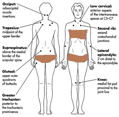 Fibro Tender Points Diagram - Wiring Diagram Pictures