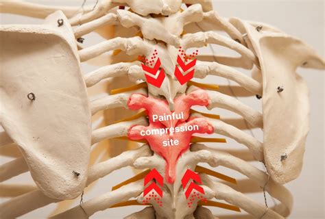 What is spinal compression? – Causes, symptoms & treatment - Spinal Backrack