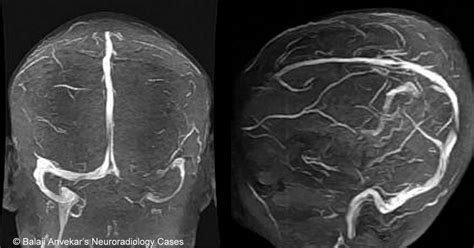 Dr Balaji Anvekar FRCR: Hypoplastic transverse sinus MRI