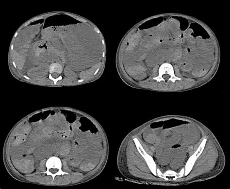 Massive gastrointestinal hemorrhage caused by Henoch-Schoenl... : Medicine