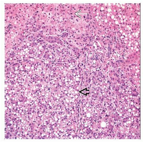 Tyrosinemia Diagnosis