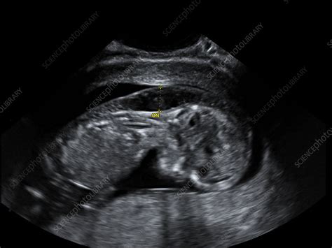 Foetus, ultrasound scan - Stock Image - C034/7065 - Science Photo Library