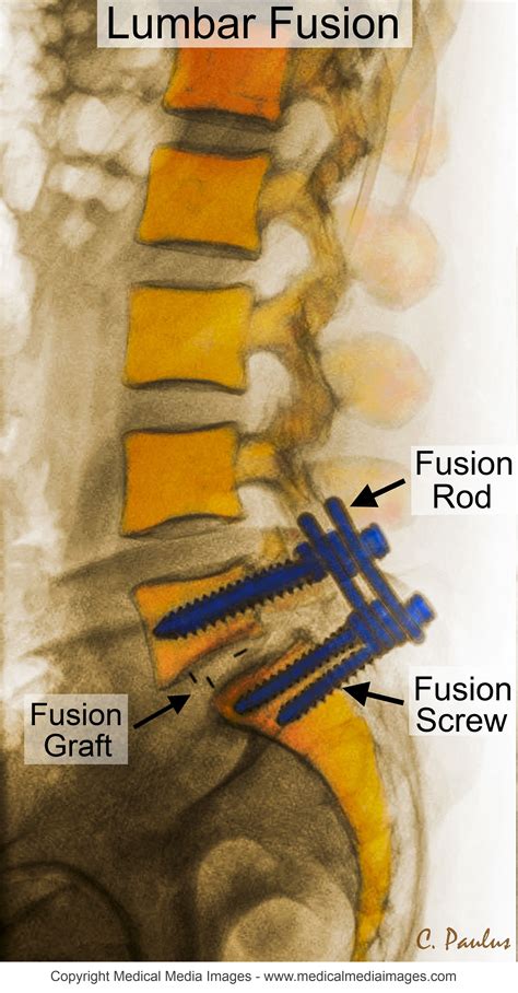 Is Lumbar Fusion Surgery A Reliable Procedure at Maureen Webb blog