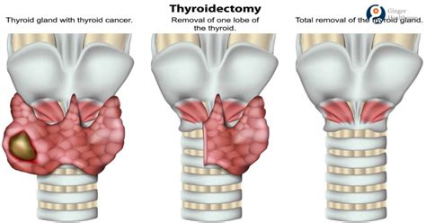 Thyroid Cancer: Causes, Symptoms, Diagnosis & Treatment options