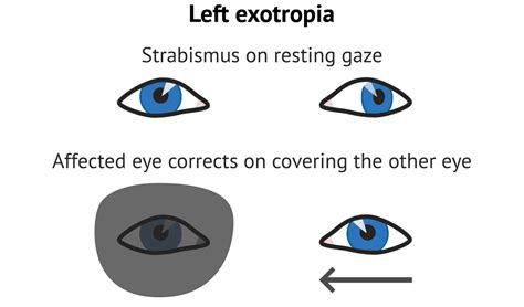 Cover Test | Signs - MedSchool