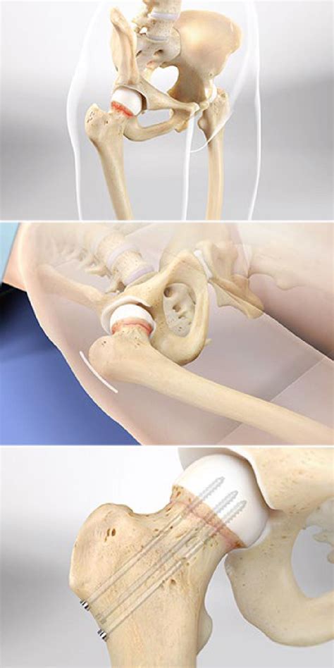 Hip Fracture