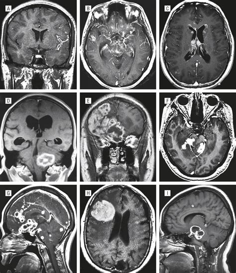 The Many Faces of Central Nervous System Tuberculosis | Infectious Diseases | JAMA Neurology ...