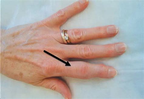 Arthritis In Knuckles Symptoms - 5 Warning Signs - Body Pain Tips