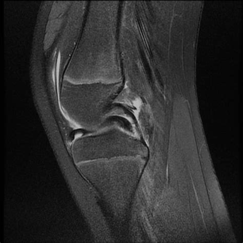 Displaced bucket handle tear of the medial meniscus. Source: CKC UK ...