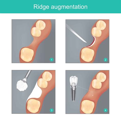 Ridge Augmentation & Ridge Modification | Sinus Elevation ...