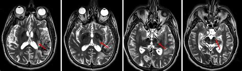 Wallerian Degeneration – Radiology Cases