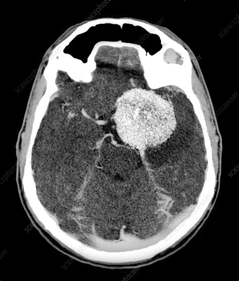 Brain tumour, CT scan - Stock Image - C026/9954 - Science Photo Library