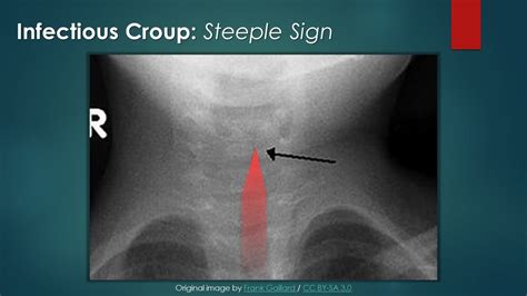 Infectious Croup: Steeple Sign - YouTube