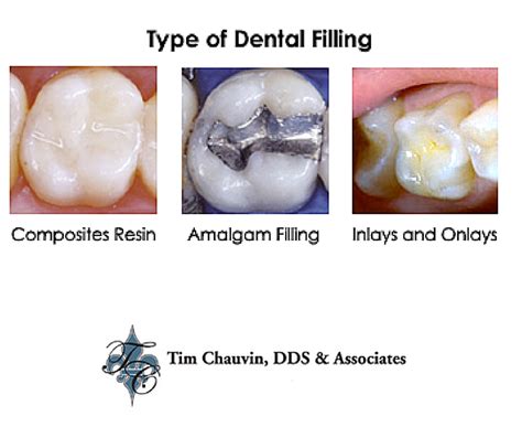 tooth colored fillings Archives - Dr Chauvin