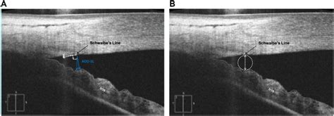 (A) An AS-OCT image of the iridocorneal angle measured using AOD-SL,... | Download Scientific ...