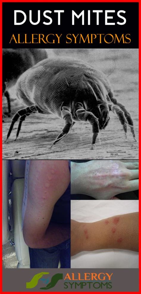 Dust Mite Allergy Symptoms and Diagnosis - Allergy Symptoms