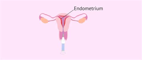 Uterine curettage - procedure, recovery and complications