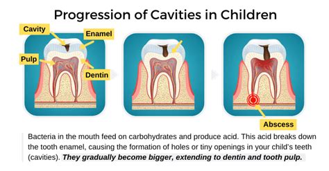 Cavities in Children - Share Dental Care