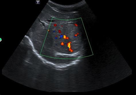 Liver mass Ultrasound - wikidoc