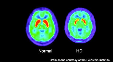 Huntington's Disease - Genetic Disorder