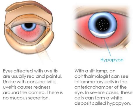 Acute Uveitis