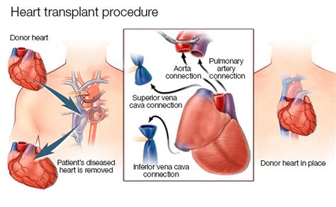 Heart Transplant - Contraindications, Procedure, Cost