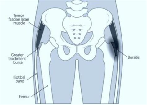 Trochanteric Bursitis Surgery