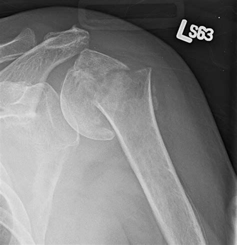 Three- and 4-part proximal humeral fracture fixation with an intramedullary cage: 1-year ...