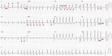 ECG Case 150: Atrial Fibrillation with Rapid Ventricular Response (RVR ...