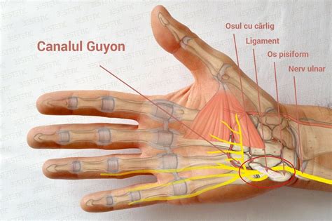 Sindromul de canal Guyon cu compresia nervului ulnar - tratament