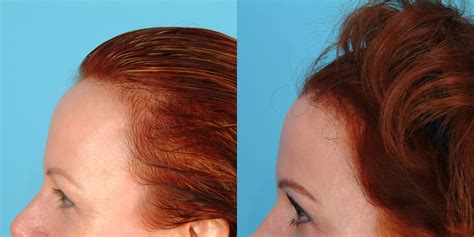 Female Hairline Lowering · Bauman Medical Group